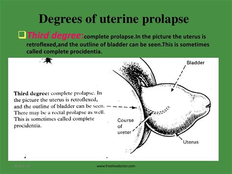 extreme prolapse porn|Extreme Prolapse Porn Videos .